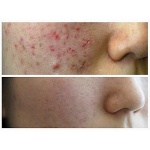 Крем для удаления следов от акне [MIZON] Acence AC Care Solution Mark X Blemish After Cream